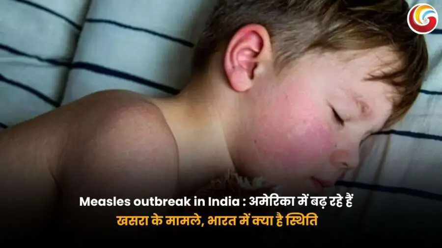 Measles Outbreak in India: बिस्तर पर सोता हुआ एक बच्चा जिसके चेहरे पर खसरे के लाल चकत्ते दिखाई दे रहे हैं, जो खसरे के लक्षणों को दर्शाता है.