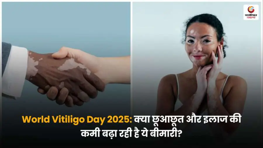 वर्ल्ड विटिलिगो डे 2025 पर जानिए क्या छूआछूत और इलाज की कमी इस त्वचा रोग को बढ़ा रही है? विटिलिगो से जुड़ी सच्चाई और जागरूकता पर आधारित महत्वपूर्ण जानकारी.