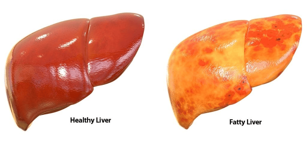 fatty liver disease