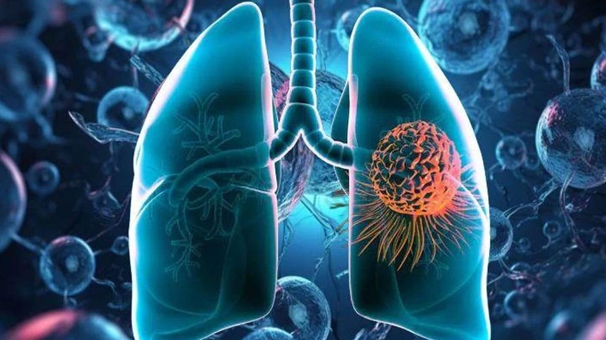 Lung cancer disease
