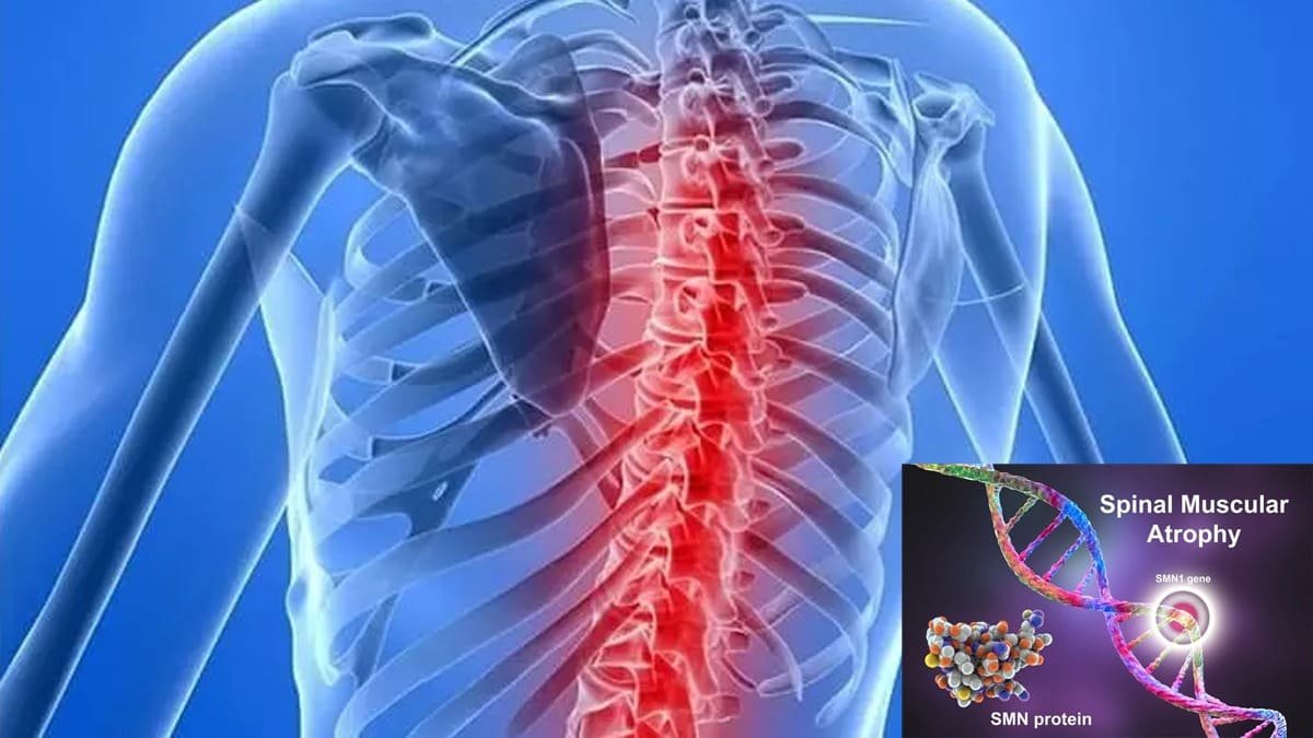 Spinal Muscular Atrophy Awareness