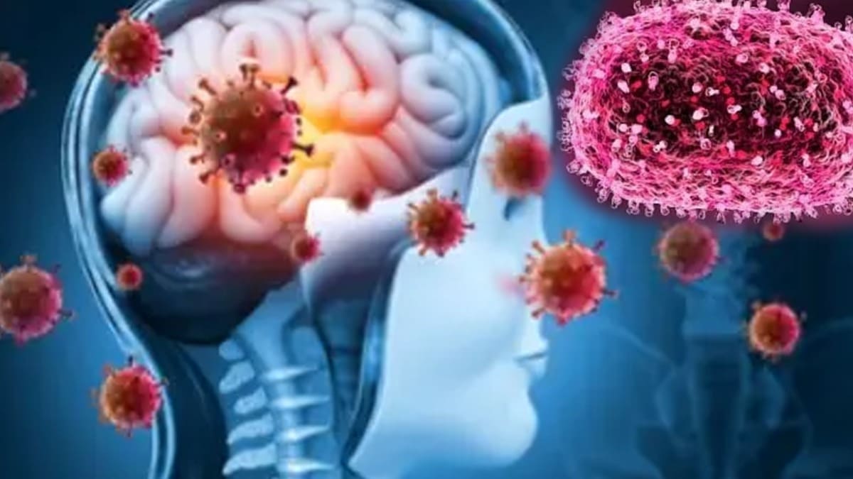 Viral Encephalitis