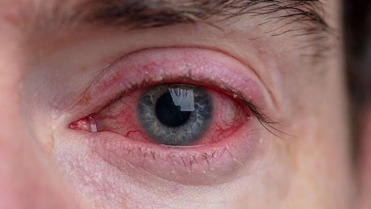 conjunctivitis disease