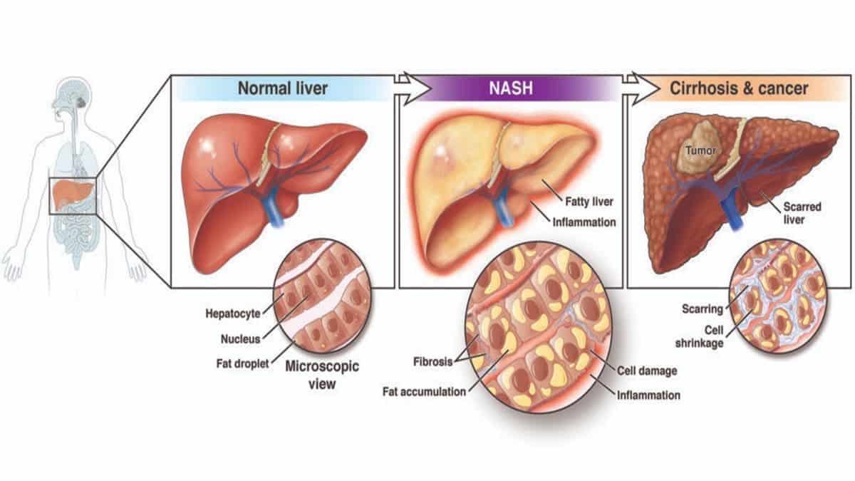 non alcoholic fatty liver disease and liver cancer