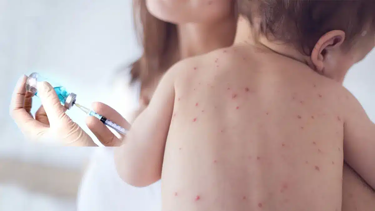 measles outbreak risks